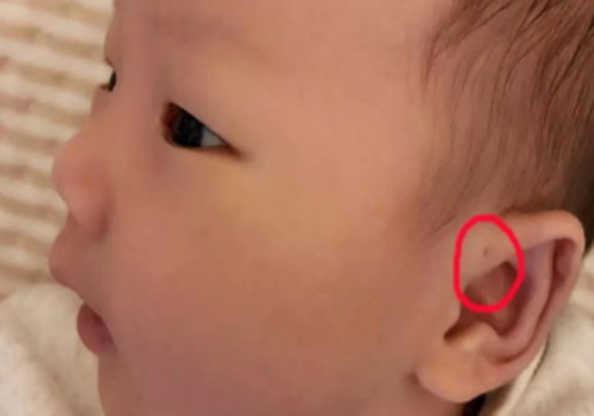 新生儿耳朵有个洞命如何,新生儿耳朵上有小孔印是耳瘘管吗