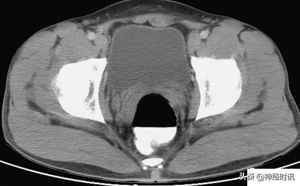 肾脏输尿管膀胱前列腺结构,肾输尿管膀胱解剖示意图