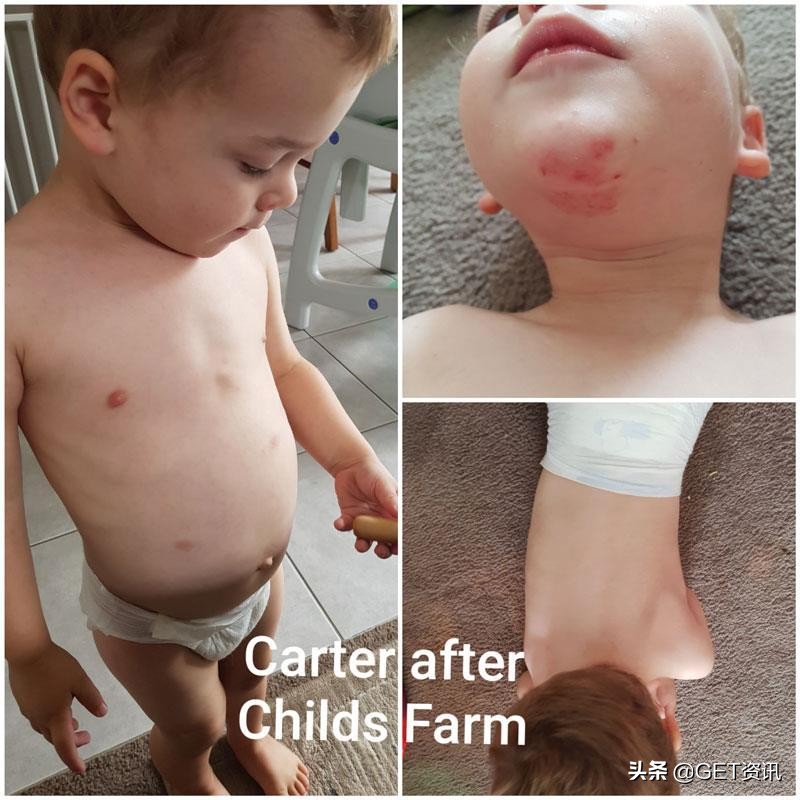 国外宝宝湿疹治疗,澳洲婴幼儿湿疹