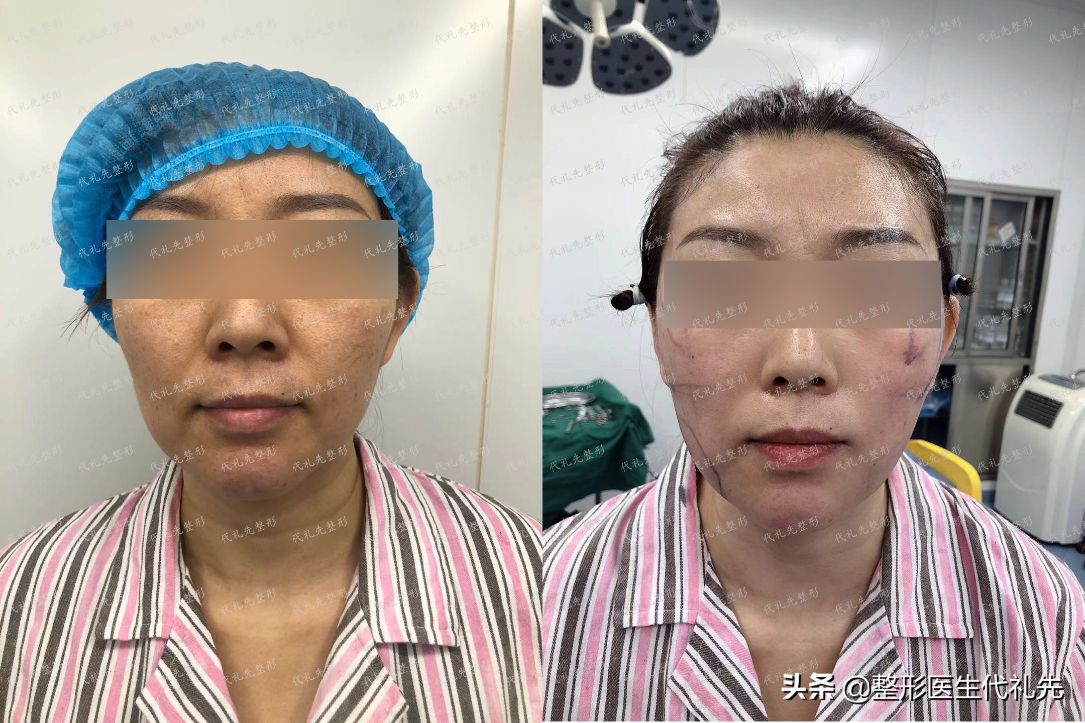 减肥后拉皮后的皮肤会松弛吗,减肥后皮肤松弛下垂怎么办图片