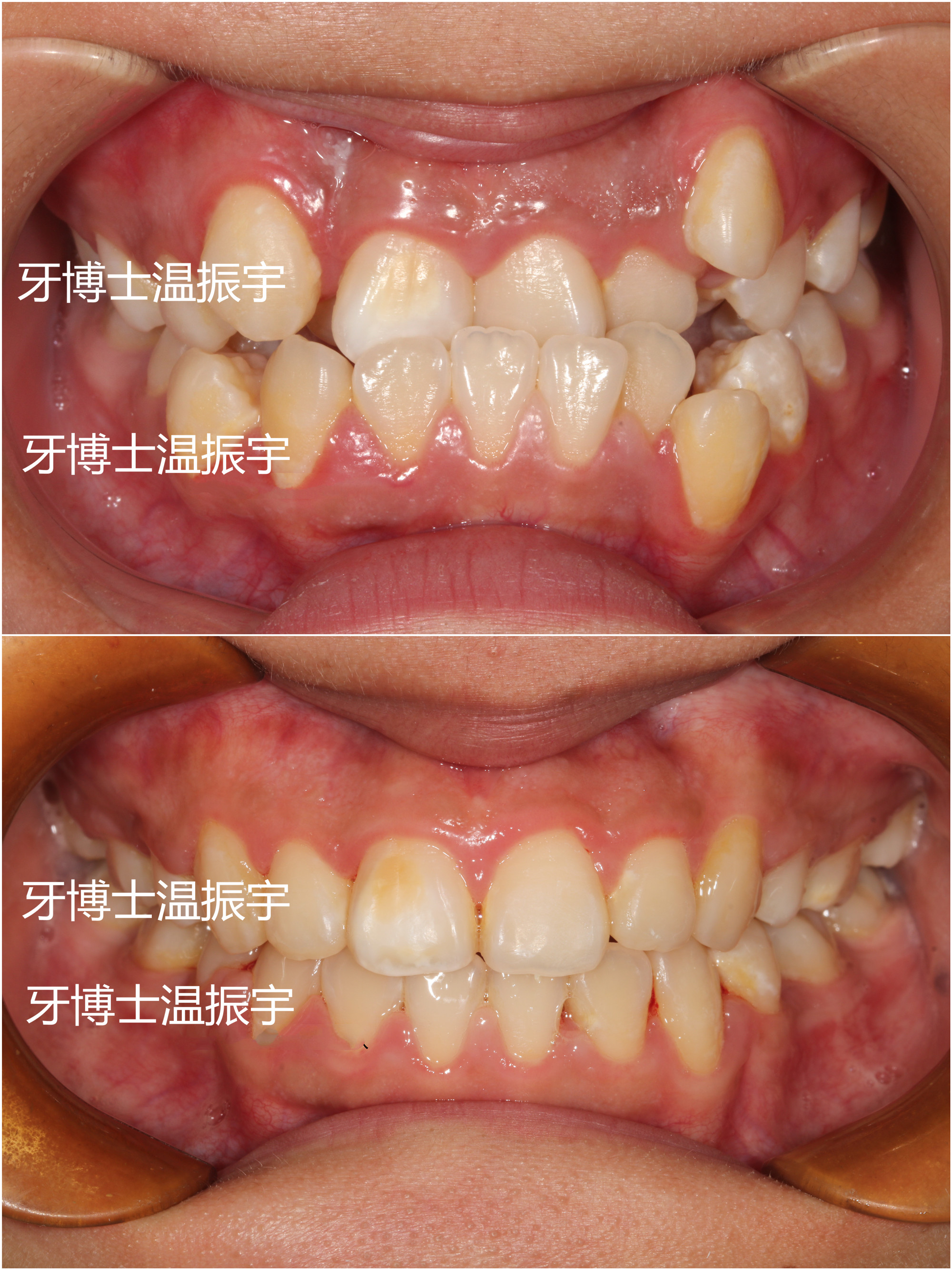 30岁了还可以做牙齿矫正吗,30岁还可以做牙齿矫正吗
