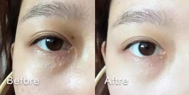 脂肪粒应该怎样用针挑,脂肪粒用针挑越挑越多