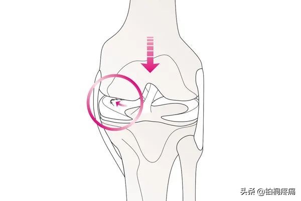 半月板受损怎么办,半月板受损是不是膝盖伸不直