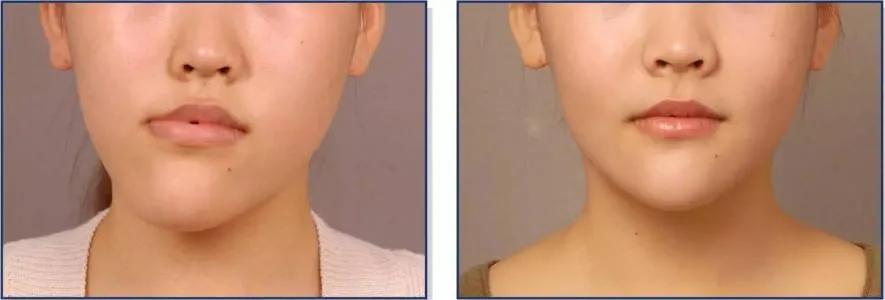 长期单边咀嚼后大小脸怎么恢复,单侧咀嚼大小脸可以恢复吗