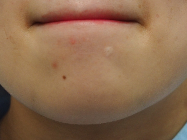 路边摆摊点痣用什么点痣,路边点痣真的可靠吗