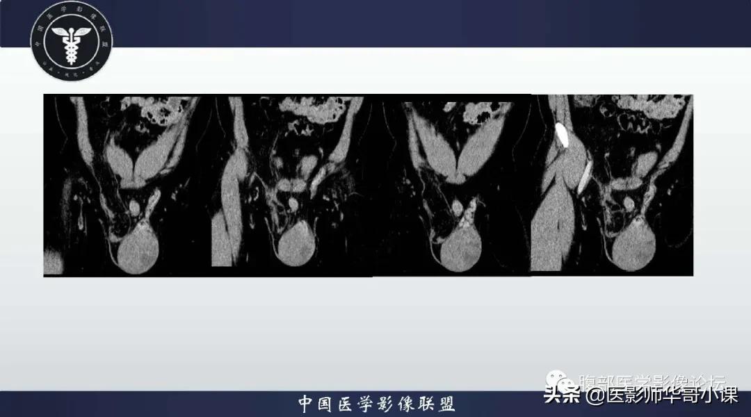 [精品课件]畸胎瘤及精原细胞瘤（*丸睾**肿瘤及肿瘤样变CT及MR表现）