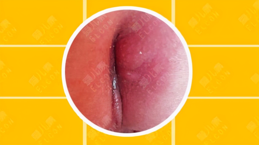 儿童预防细菌感染疫苗,婴儿肛周脓肿接种禁忌