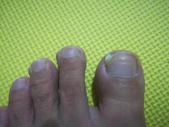 甲沟炎经验分享,甲沟炎的自愈经历