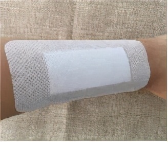 包皮术后多久拆线,术后拆线后要注意些什么