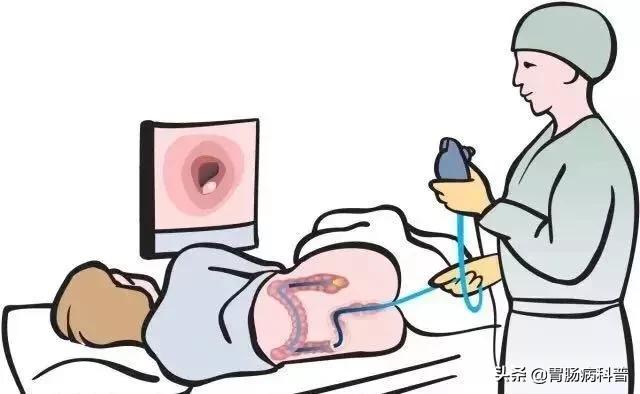 肠镜检查前后的注意事项有哪些,肠镜检查前后的注意事项是什么