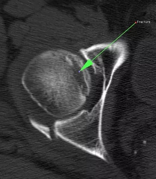 几种严重骨折医学名称,常见的骨折有哪些名称