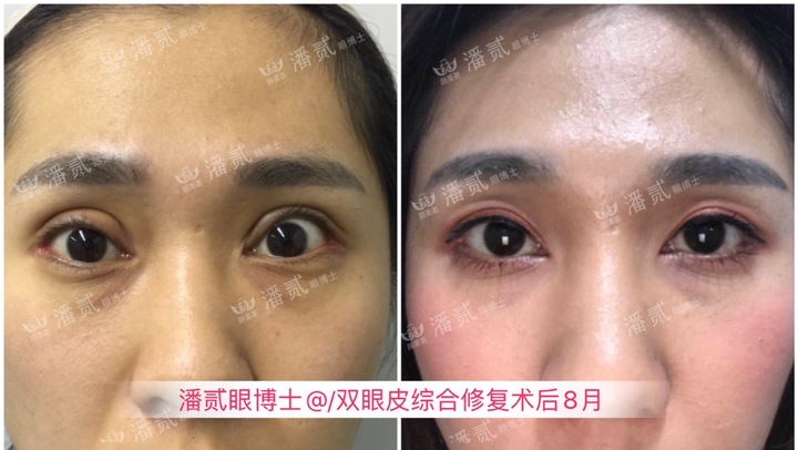 割双眼皮眼皮压下来会恢复吗,割双眼皮以后会松弛更快吗