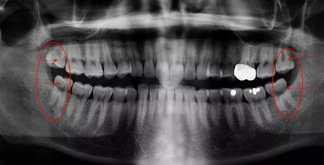 智齿必须拔掉的五种情况图片,智齿一定要拔吗4种情况必拔