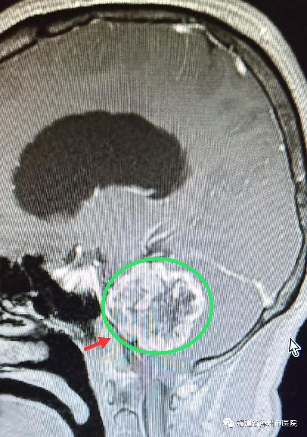 听力下降是耳朵出问题吗,着急一侧耳朵耳鸣听力减退