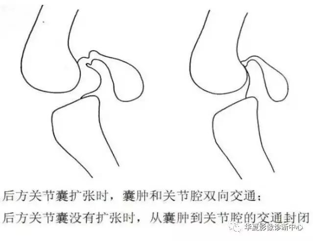 膝关节痛警惕四种病,科普膝关节疼痛影响到的22种疾病