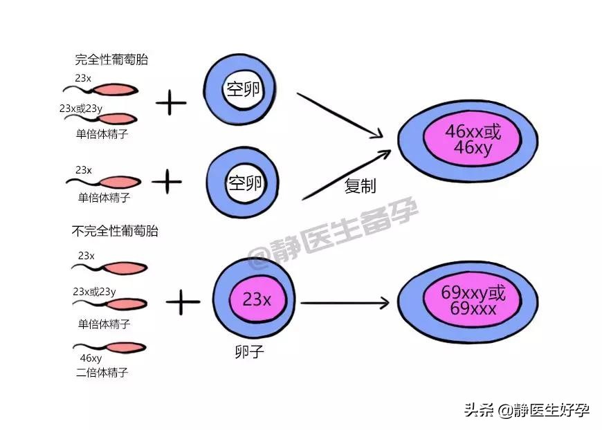 静医生备孕：“怪胎”还是“鬼胎”？葡萄胎了解一下