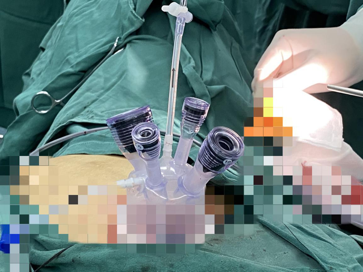 南大二附院妇产科完成一例经脐单孔腹腔镜卵巢恶性性索间质肿瘤全面分期手术