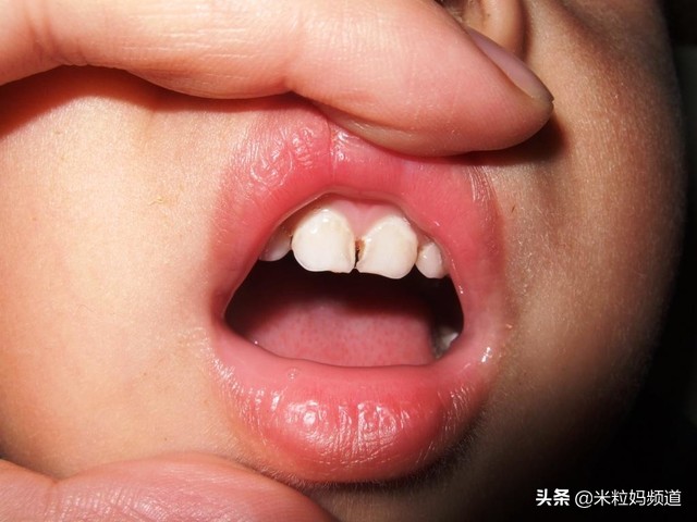 小朋友的蛀牙是怎么形成的,10岁小孩有7颗蛀牙