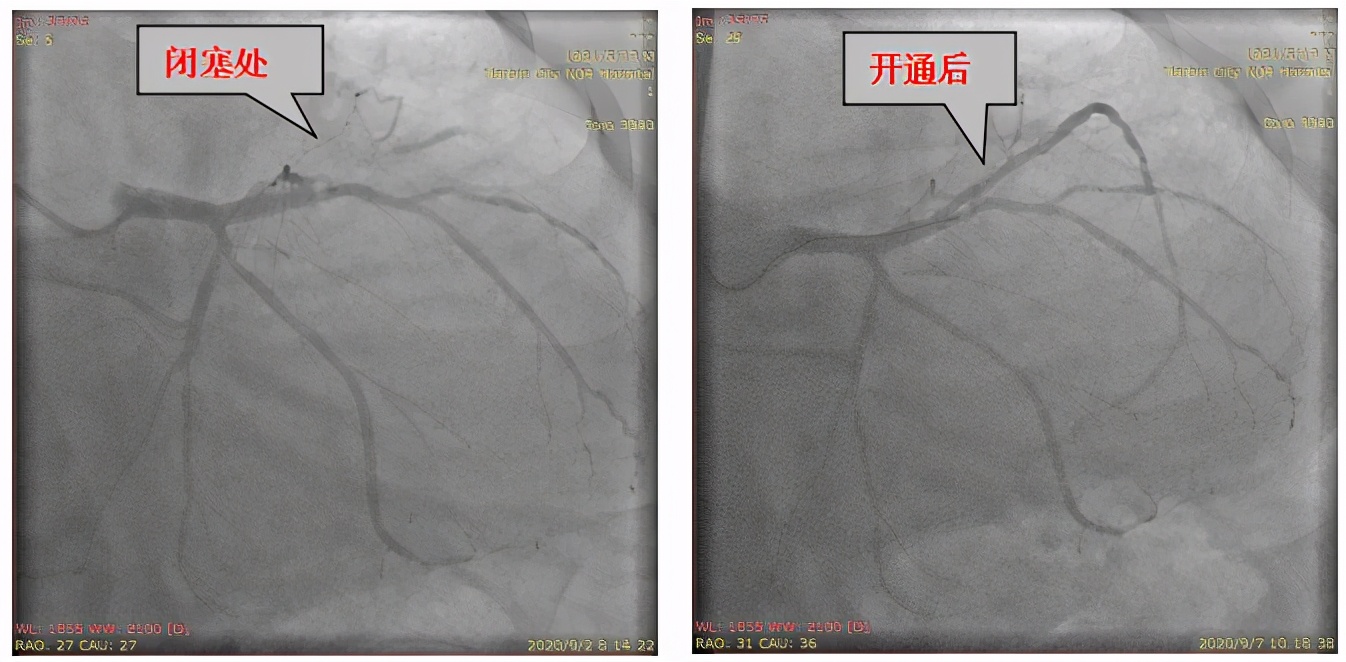 心梗导致心衰可以不做支架,心梗可以不做支架只疏通吗