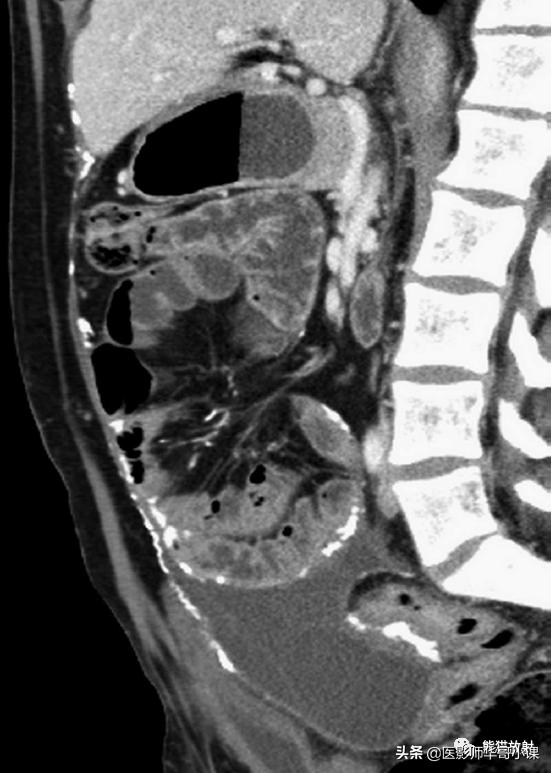 「精品课件」11种腹膜感染/炎症性病变的影像学表现