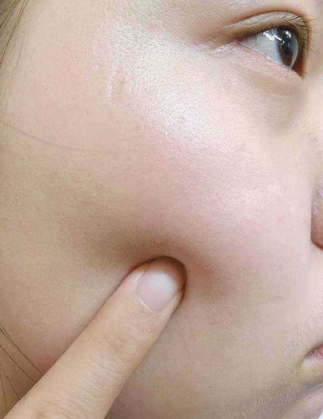 眼睛下面毛周角化症怎么治,眼睛下方毛周角化可以治疗吗