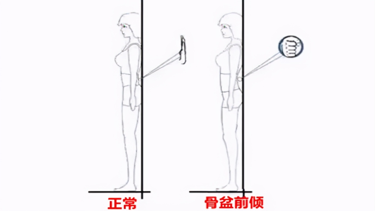 屁股翘腰疼怎么矫正,屁股翘会腰突吗