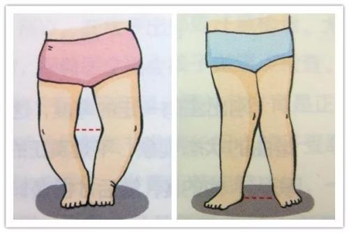 宝宝佝偻病补充d的剂量,佝偻病的孩子怎么补充d3