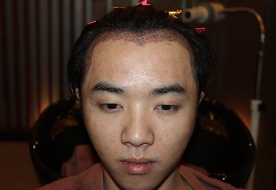 疑似华晨宇女友放锤！曝光其植发整容照，怒斥张碧晨插足当小三