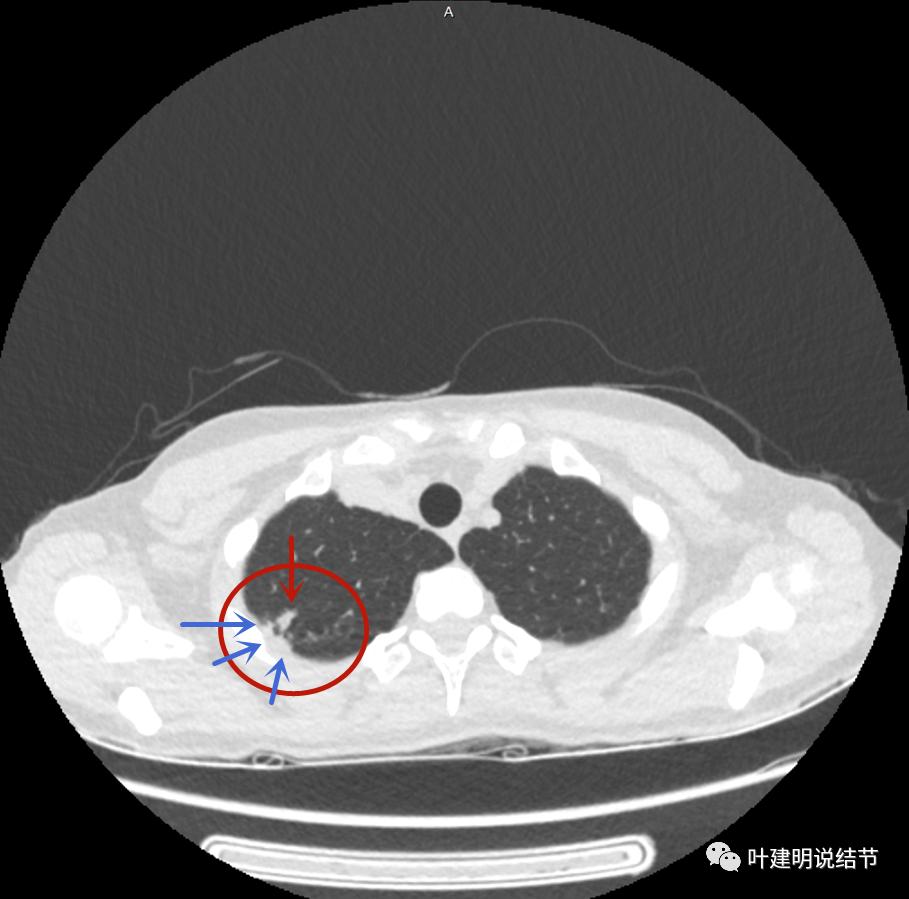 临床诊断孤立性肺结节,空洞型结节一般是什么性质