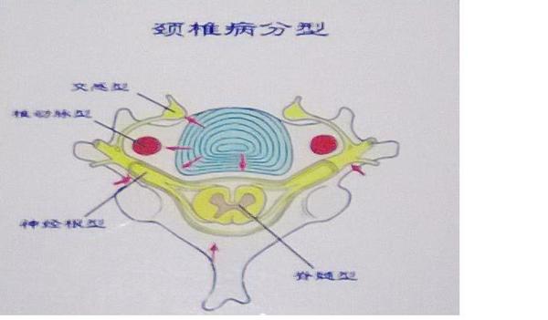 什么是腰突什么是膨出怎么区分？