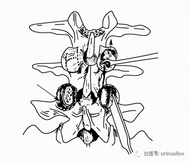 植骨手术的成功攻略,什么情况需要植骨手术全过程