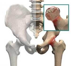 儿童股骨头坏死是怎么引起的,长期吃激素药怎样预防股骨头坏死