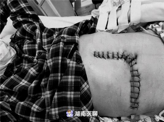 大爷腹痛入院检查现肾癌！医生手术去瘤，肚皮上留“巨型蜈蚣”