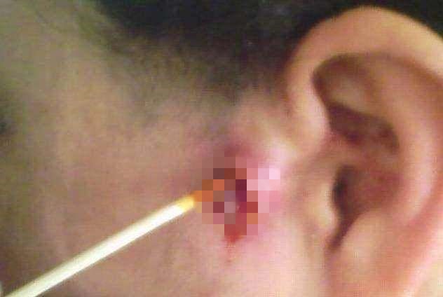 小孩一出生就有耳孔,宝宝有耳孔必须手术吗