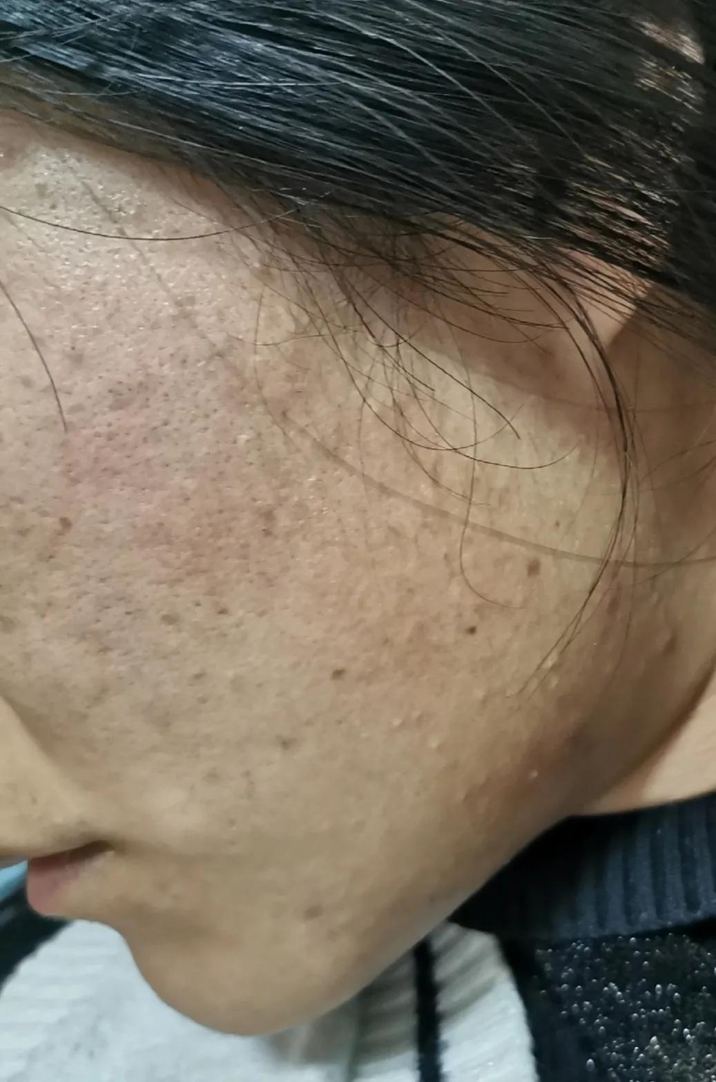 吐血总结祛痘膏,反反复复爆痘怎么都不管用