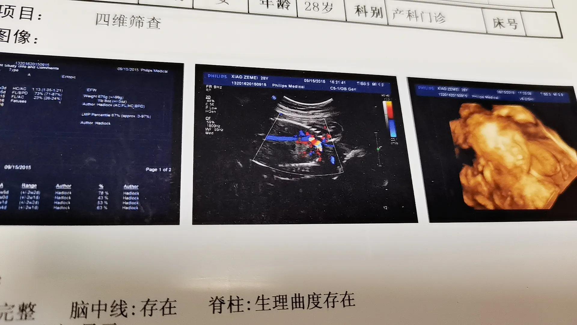 虚惊一场钼靶4b结果活检为良性,虚惊一场复查无大碍