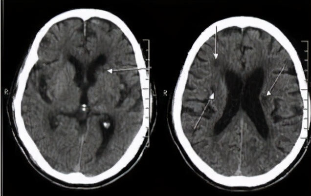 高血压大脑有什么影响,更年期高血压的症状和表现
