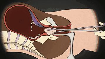 打胎有多可怕案例,20岁女生堕胎7次