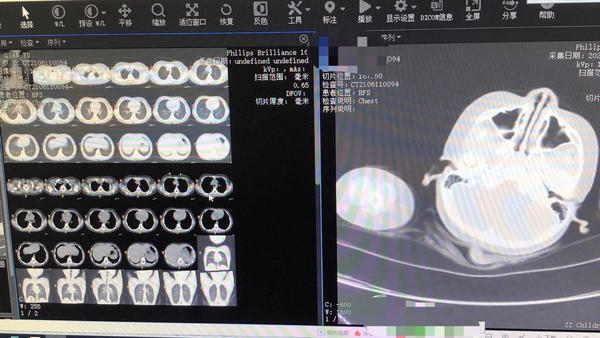 孩子夏天游泳要注意！郑州7岁女童呛了水，咳嗽几天后，被确诊“吸入性肺炎”