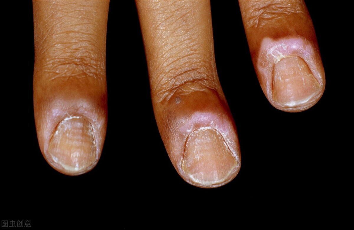 脚趾疼甲沟炎用药,甲沟炎引起脚趾痛怎么办