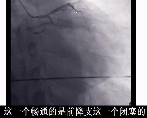 60岁冠心病胸闷气短吃什么药,冠心病患者出现胸闷后怎么处理