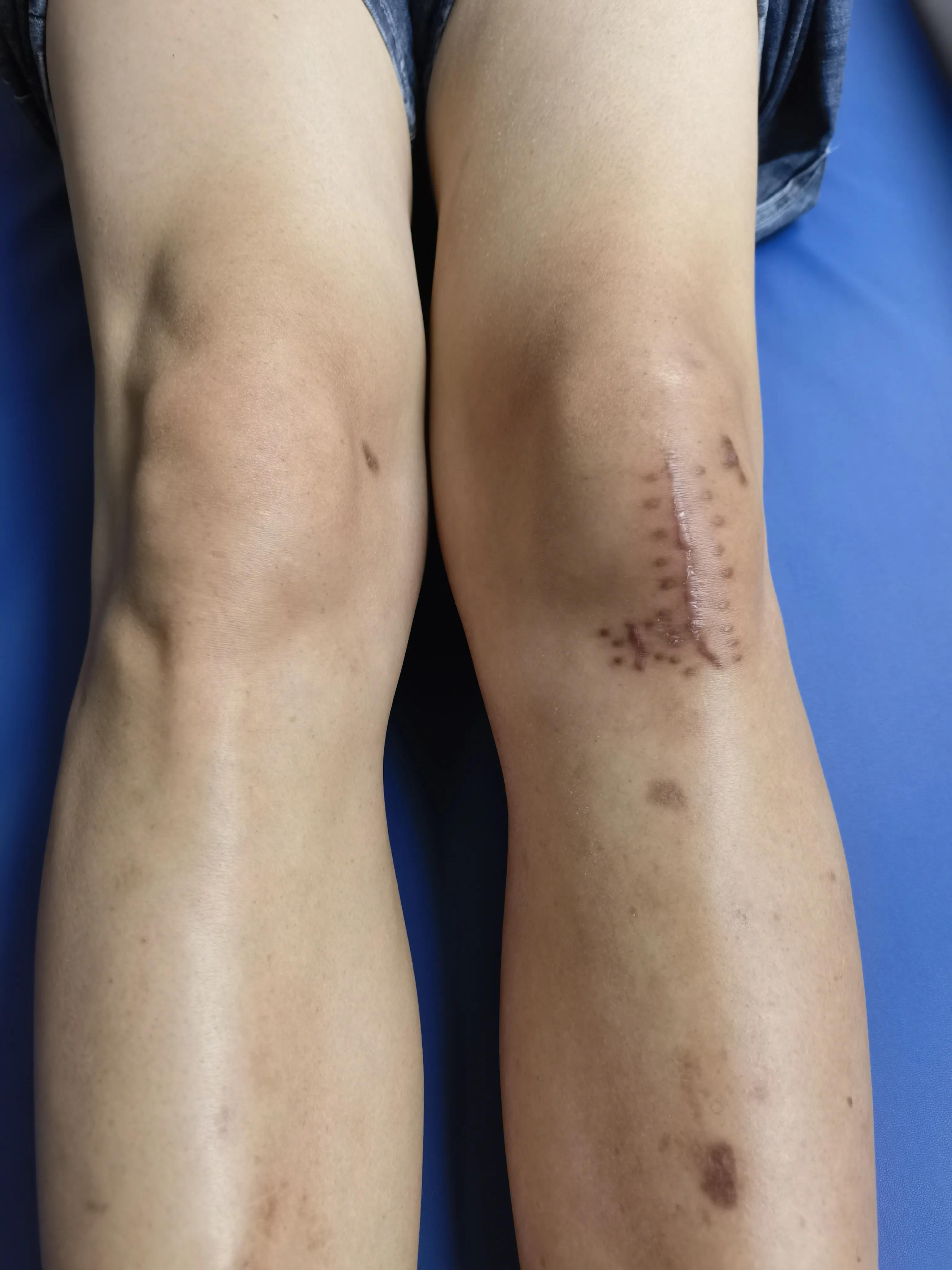 骨折后大腿肌肉萎缩,胫骨平台骨折导致大腿肌肉萎缩