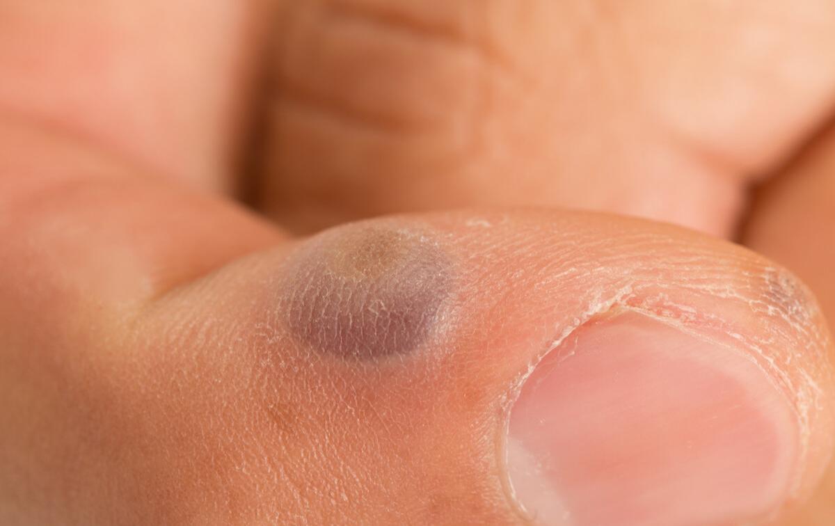 法令纹去除应该填充还是去皱,法令纹除了填充就没其他方法了吗