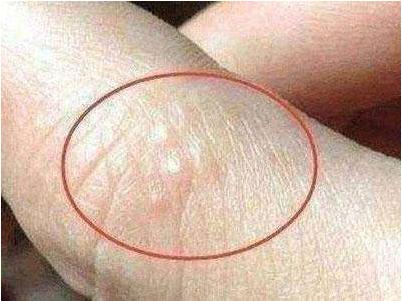 汗疱疹怎么处理,脚部汗疱疹怎么处理