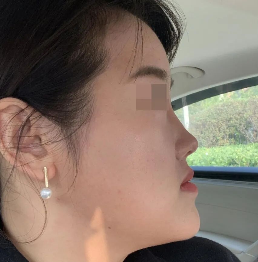 鼻部不立体,鼻部垫高