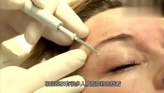 脂肪粒别用针挑教你一个土办法,脂肪粒怎么用针挑出来不疼