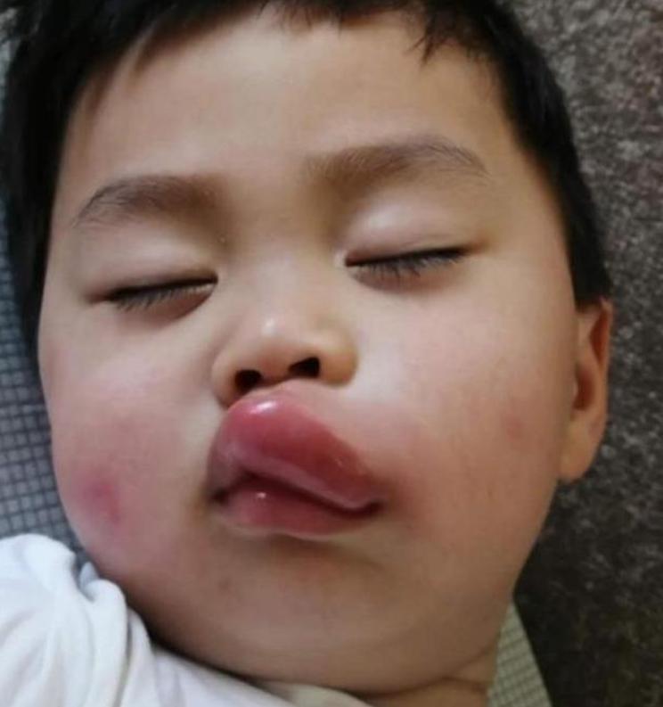 小孩嘴巴肿了一块,小孩嘴巴突然肿了