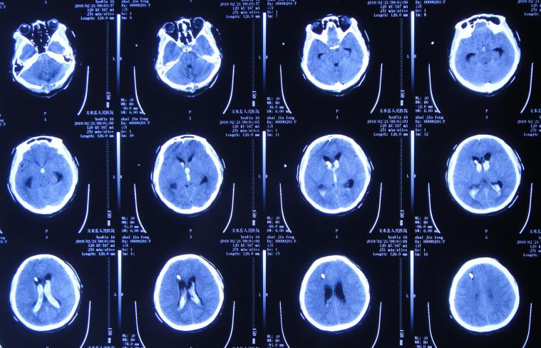 脑出血后脑积水会造成意识不清吗,脑出血后脑积水发高烧危险期多久