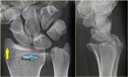 几种严重骨折医学名称,常见的骨折有哪些名称