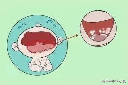 宝宝口腔白斑鹅口疮怎么治疗,宝宝鹅口疮需要将白斑擦掉么